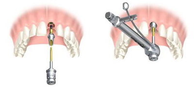 implants-dentaires-5